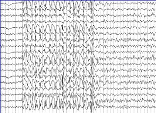 EEG-ABSENCE.JPG