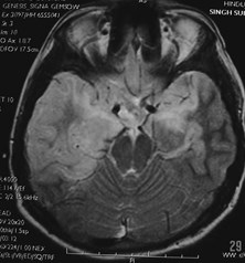 G:\Pead Neurorad\Herpes Encephalitis\Herpes 8.jpg