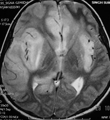 G:\Pead Neurorad\Herpes Encephalitis\Herpes 5.jpg