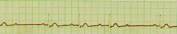 http://courses.washington.edu/conj/ecg/ecg5.gif